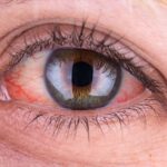 Göz Tansiyonu: Belirtileri, Türleri, Teşhisi ve Tedavisi